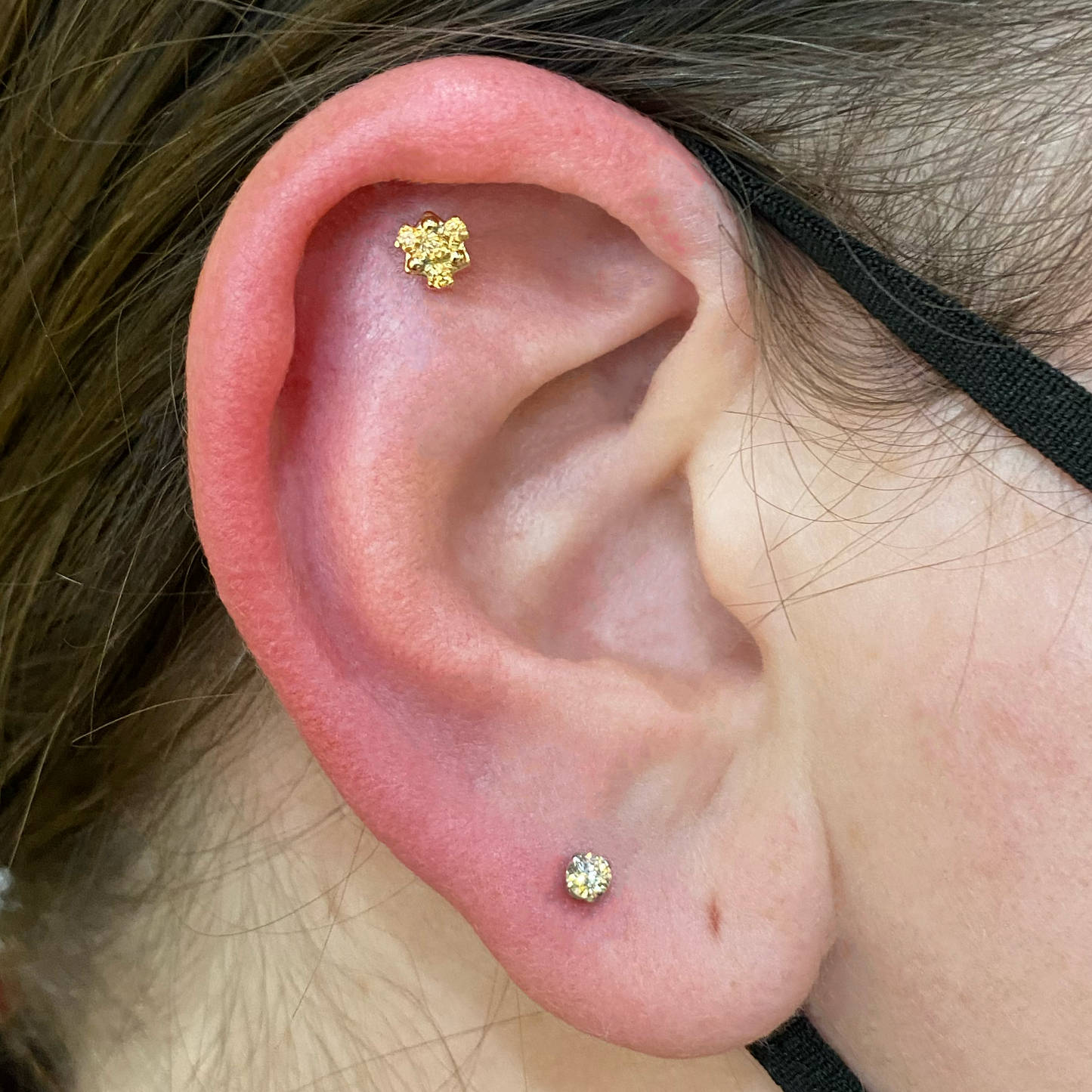 Helix (Ear Cartilage)